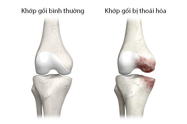 sụn khớp bình thường và sụn khớp bị thoái hóa