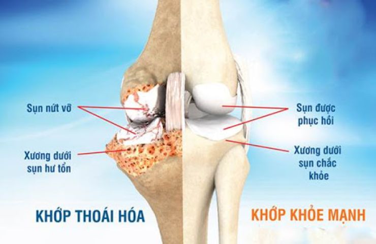 phân biệt sụn khớp bình thường và thoái hóa khớp