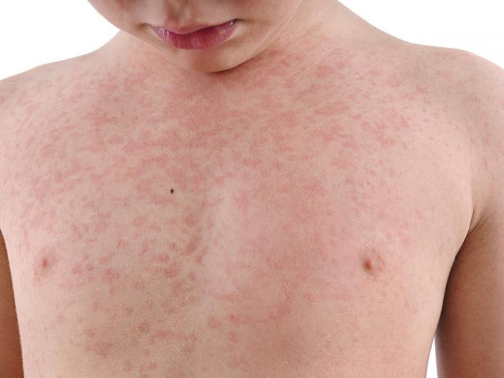 Phát ban là một trong những triệu chứng điển hình của bệnh sởi rubella